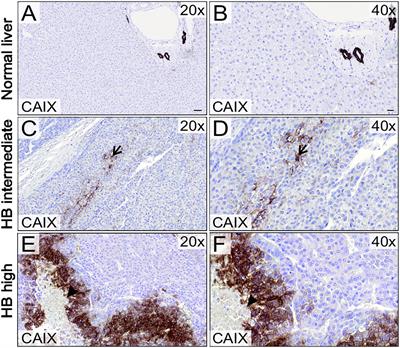 SLC-0111, an inhibitor of carbonic anhydrase IX, attenuates hepatoblastoma cell viability and migration